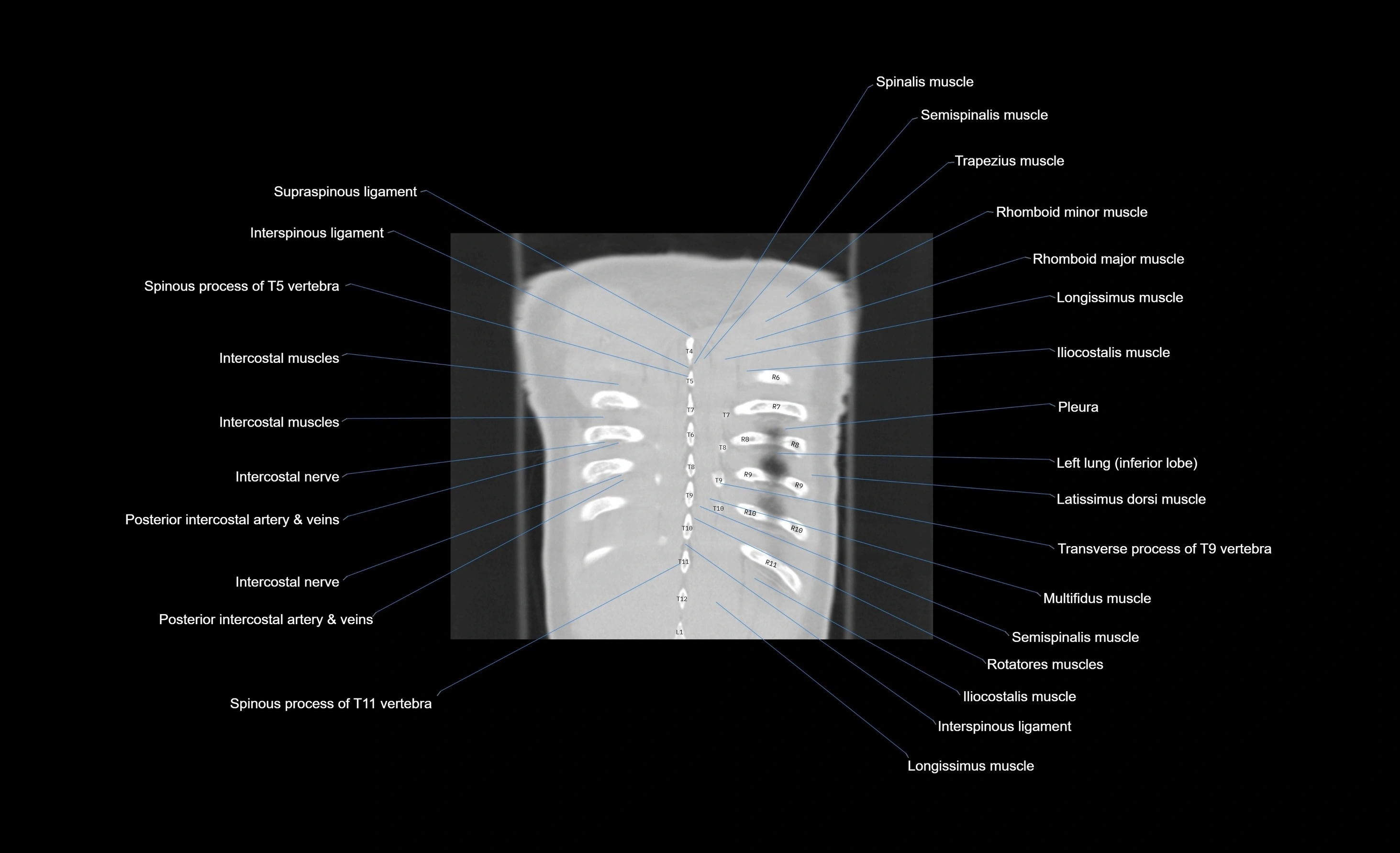CT chest (thorax) labelled coronal cross sectional anatomy radiology image-00014.webp
